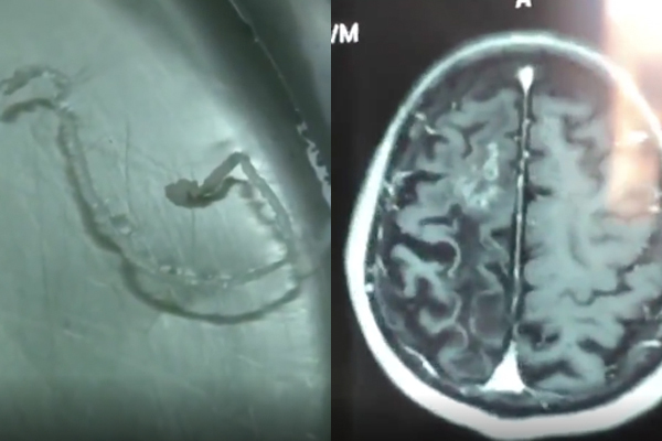 Người đàn ông đau đầu 30 năm, bác sĩ lôi ra sinh vật 10cm trong não
