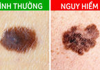 5 tín hiệu từ nốt ruồi cảnh báo ung thư đang tiềm ẩn dưới làn da