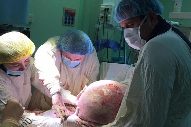 Bác sĩ nhảy ăn mừng sau khi gỡ bỏ thành công khối u khổng lồ 25kg