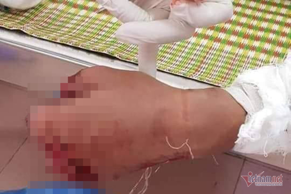 Thanh niên Quảng Trị nát bàn tay vì dùng điện thoại khi đang sạc