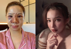 Lưu Đê Ly gây sốc khi công bố ảnh gương mặt biến dạng sau phẫu thuật
