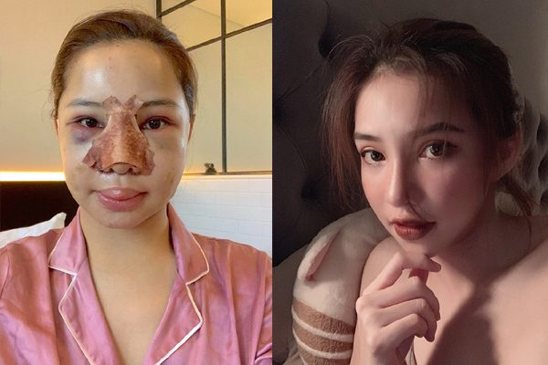 Lưu Đê Ly gây sốc khi công bố ảnh gương mặt biến dạng sau phẫu thuật