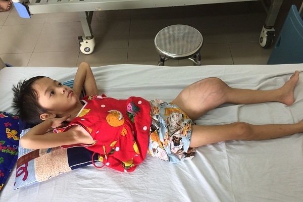 Bố bỏ rơi lúc mới đẻ, mẹ trầm cảm, bé gái suy kiệt vì ung thư xương