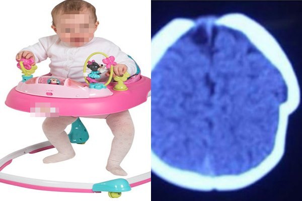 Mẹ bất cẩn, hộp sọ bé gái 8 tháng bị lún sâu