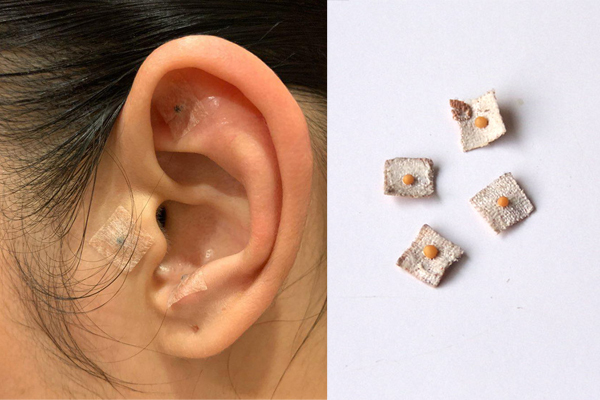 Bất ngờ trước phương pháp giảm cân nhanh bằng dán hạt giống lên tai