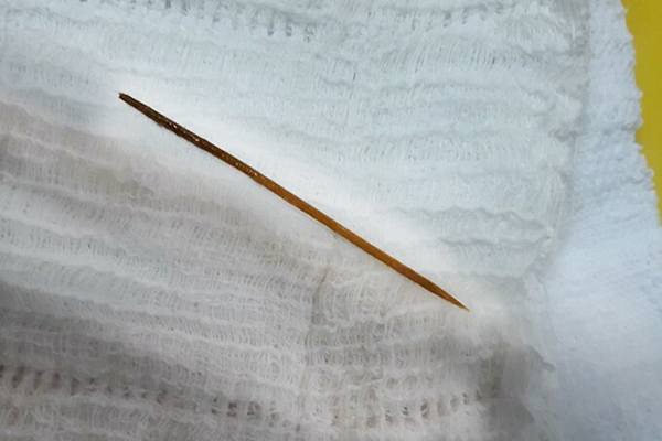 Người đàn ông ngủ quên, nuốt tăm 6cm vào bụng