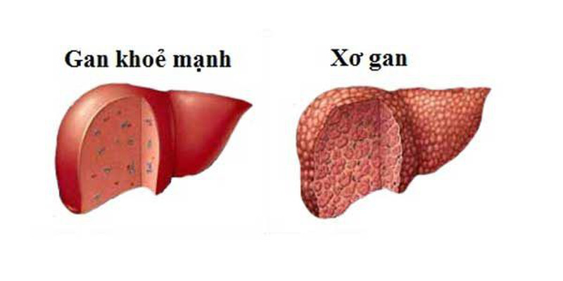 5 tín hiệu ít ai ngờ của xơ gan, báo hiệu bạn cần đến bệnh viện ngay