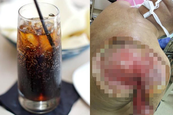 Uống 2 chai nước ngọt mỗi ngày, cánh tay người đàn ông thối rữa, hoại tử