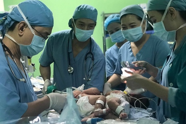 Cặp song sinh dính liền chung 1 lá gan được phẫu thuật tách rời