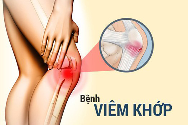 Hoạt chất nguồn gốc tự nhiên hỗ trợ đẩy lùi viêm khớp