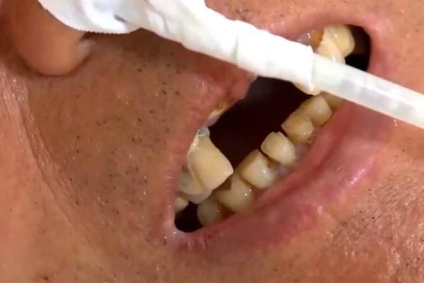 Nhập viện cấp cứu vì nuốt phải răng giả trong khi ăn cháo