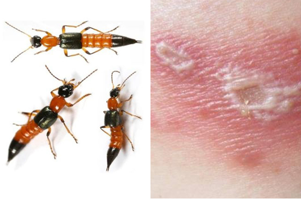 Nọc kiến ba khoang độc hơn rắn hổ 15 lần, cách chữa thế nào?