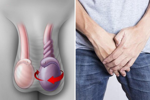 Nam thanh niên 30 tuổi vào viện cấp cứu vì tinh hoàn sưng to