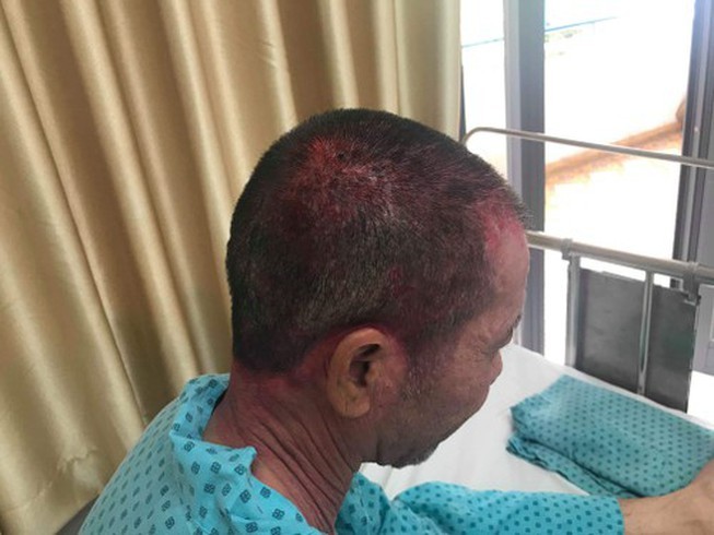 Người đàn ông nhập viện cấp cứu vì dùng thuốc nhuộm tóc