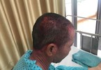 Người đàn ông nhập viện cấp cứu vì dùng thuốc nhuộm tóc