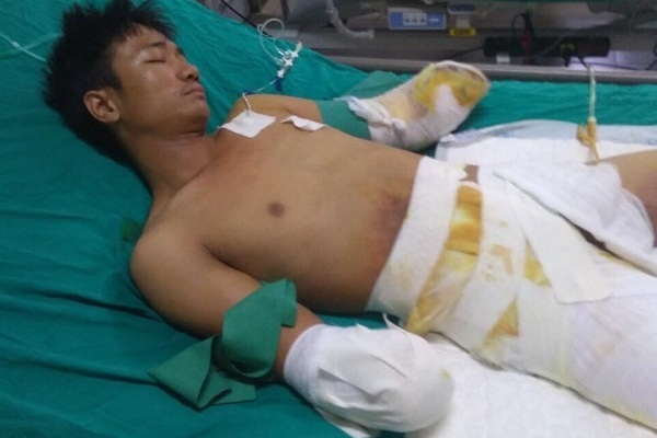 Gia cảnh bi đát của người đàn ông bị điện giật cắt cụt 2 tay