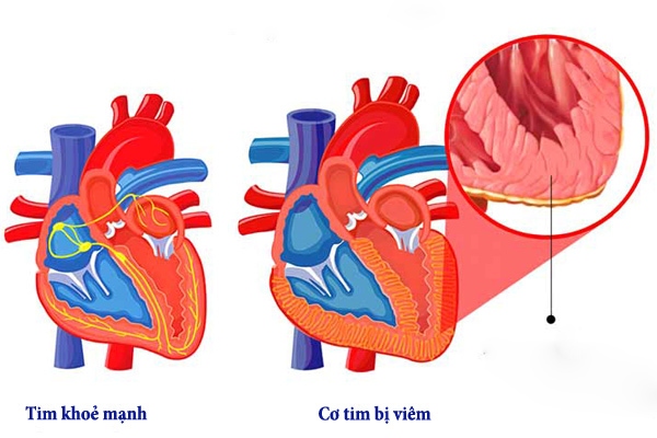 Sau 2 ca tử vong ở Hà Nội, bệnh viêm cơ tim nguy hiểm thế nào?