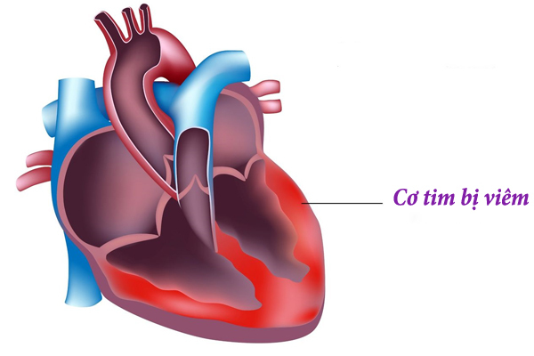 Triệu chứng dễ bỏ qua khiến 2 phụ nữ Hà Nội tử vong do viêm cơ tim