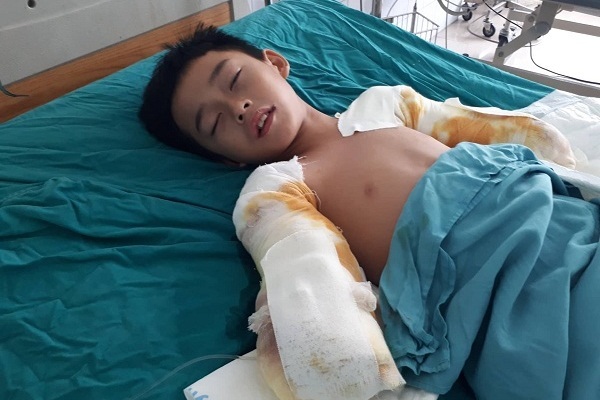 Nhói lòng cảnh bé trai bị điện giật cắt cụt hai cánh tay, nguy cơ còn hoại tử