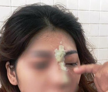 Cô gái 21 tuổi mù mắt sau khi tiêm filler nâng mũi