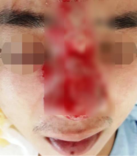 Thanh niên suýt mù mắt sau tiêm filler nâng mũi ở spa