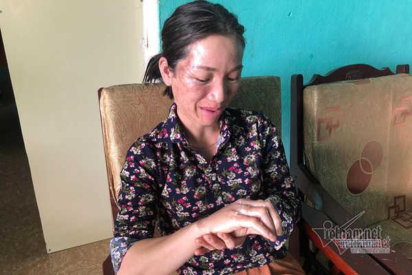 Nữ cán bộ ở Vân Đồn bị ném bom xăng bỏng mặt và tay