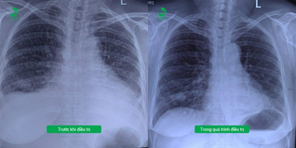 BV Thu Cúc kiểm soát thành công khối u phổi ác tính