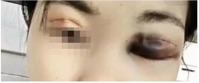 Cô gái trẻ không thể nhắm mắt sau phẫu thuật cắt mí