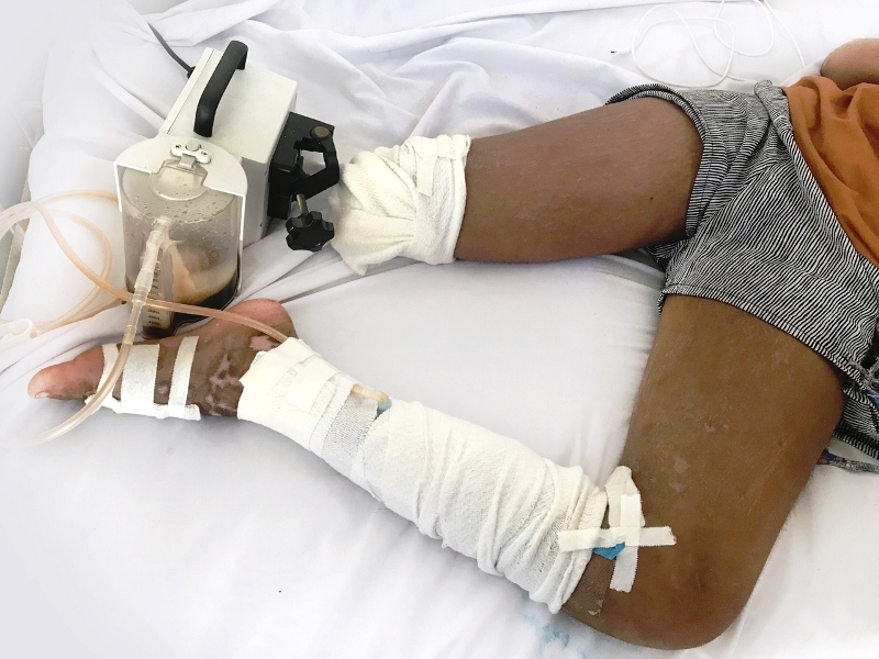 Bé gái bị rắn cắn phải cắt chân sau khi lang “băm” cắt lễ, hút máu