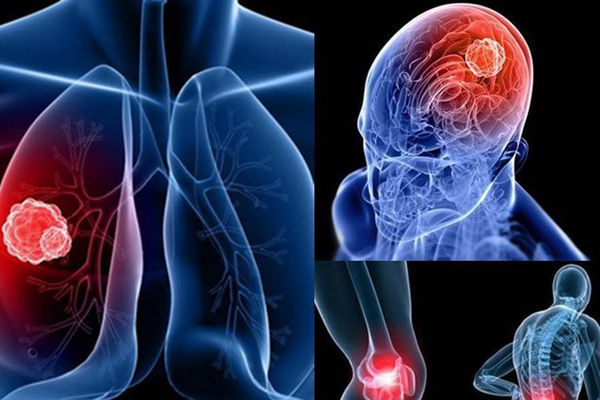 Ho mãi không khỏi, bác sĩ thông báo chỉ còn sống vài tháng vì mắc 3 ung thư cùng lúc