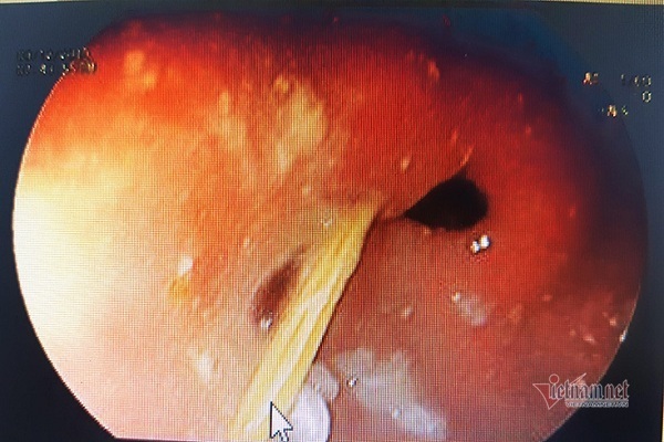 Tăm nhọn đâm thủng dạ dày nam thanh niên ở Quảng Bình