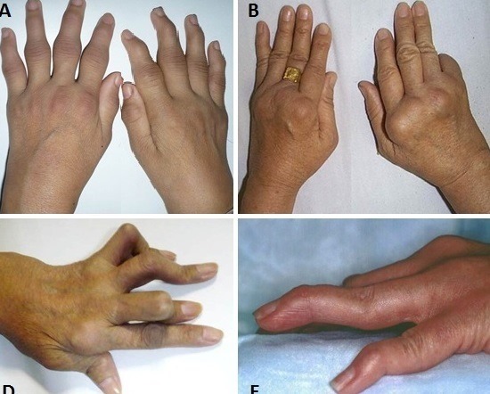 Tự ý điều trị bằng thuốc nam chữa khớp, người đàn ông suýt tàn phế