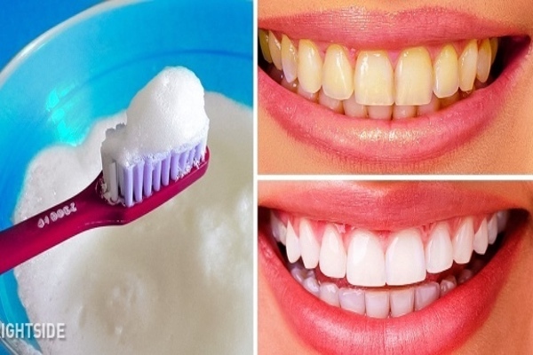 Sau sinh răng bị vàng có hại không? Bật mí cách làm trắng răng sau sinh