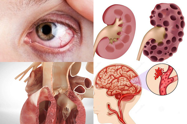 Căn bệnh giết người hàng đầu, 14 triệu người Việt Nam đang mắc