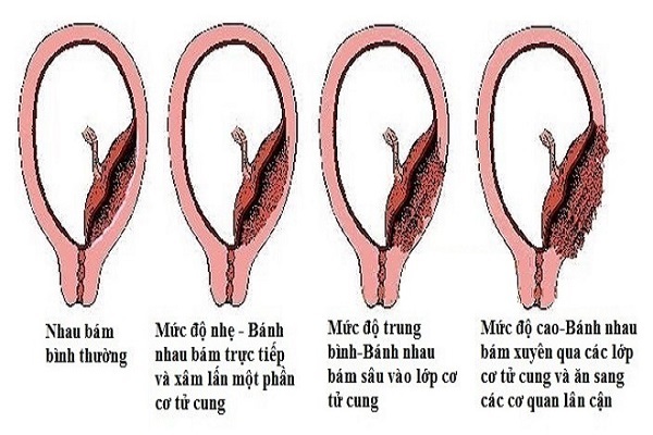 Sản phụ suýt tử vong vì sinh mổ liên tiếp, rau cài răng lược