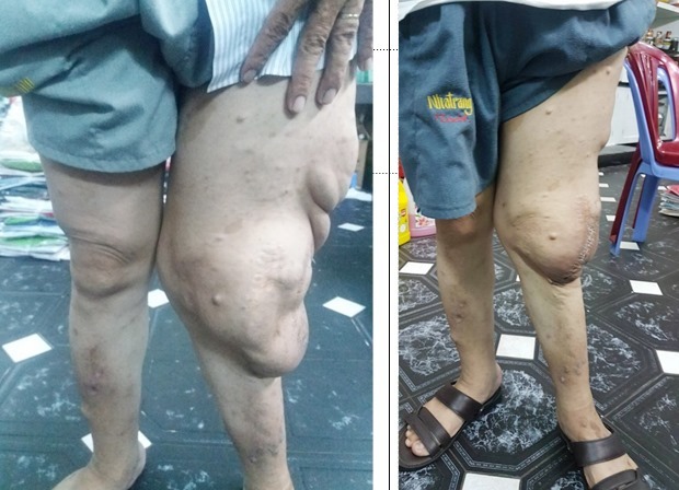 Giải cứu 'chân voi' cho người đàn ông có khối bướu nặng 2,5 kg