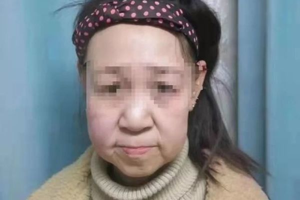 Có gương mặt như cụ bà 60, cô gái 15 tuổi phải bỏ học giữa chừng
