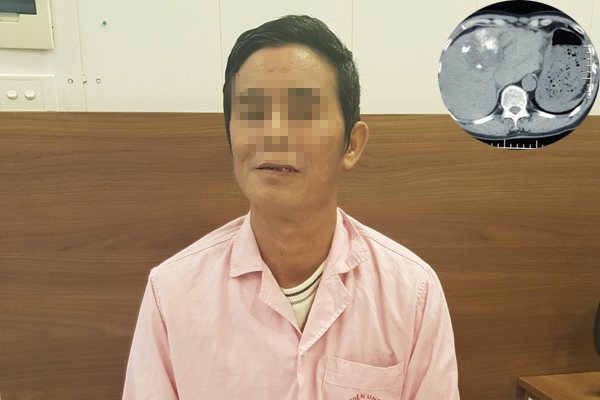 Bệnh nhân ở Hà Nội bị ung thư gan, khối u vỡ nát trong bụng