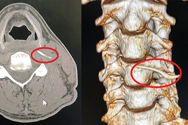 Uống ‘nước thần’ chữa hóc xương, người đàn ông nhập viện khẩn cấp
