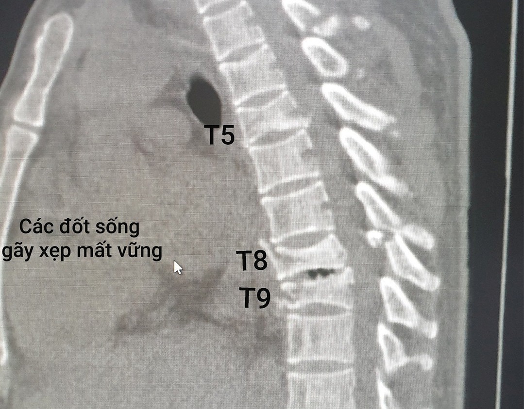 Vật nặng rơi trúng đầu, ngực người đàn ông suýt liệt toàn thân