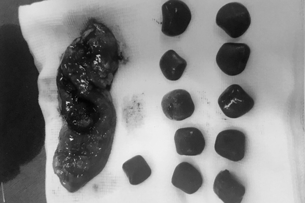 Sỏi to lúc nhúc trong mật người đàn ông Phú Thọ