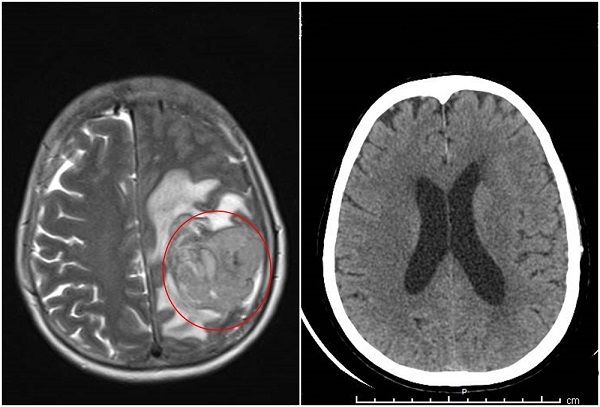 Người phụ nữ nguy kịch do khối u não khổng lồ