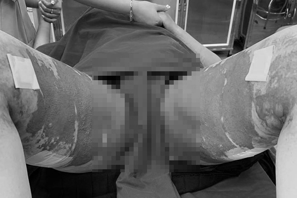 Đôi chân biến dạng của cô gái 28 tuổi sau hút mỡ tại thẩm mỹ viện Việt Hàn