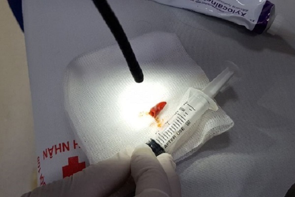 Phế quản người đàn ông đóng mủ do thói quen ăn ớt sai cách