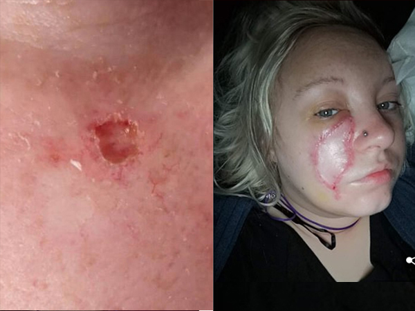 Vết sẹo thủy đậu trên mặt người phụ nữ phát triển thành ung thư