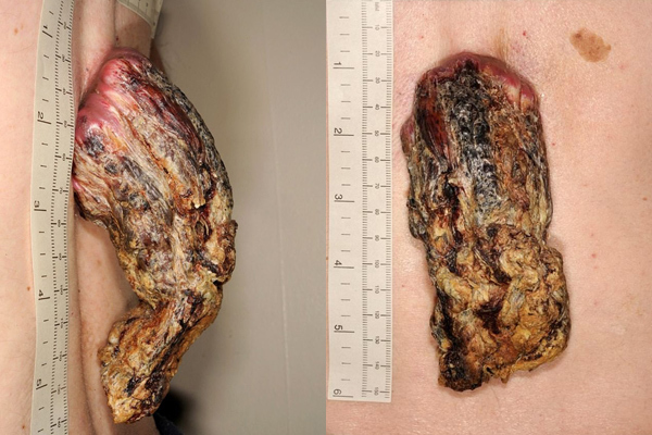 Sừng trồi lên giữa lưng người đàn ông mắc ung thư