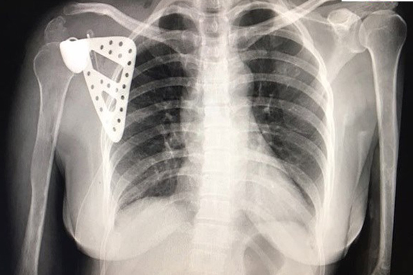 Chủ quan với cơn đau bả vai, cô giáo Hà Nội bị ung thư xương mà không biết