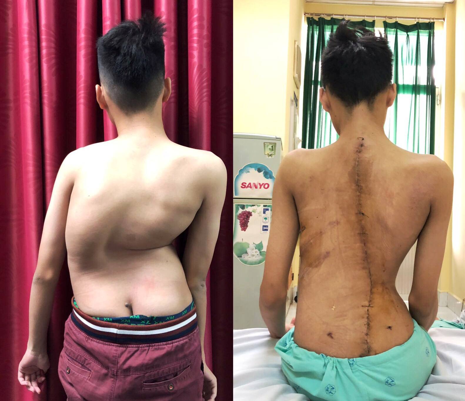 Ca phẫu thuật giúp thiếu niên 17 tuổi cao thêm 8cm sau 1 đêm