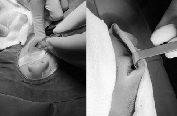 Liên tiếp cấp cứu trẻ bị tai nạn sinh hoạt