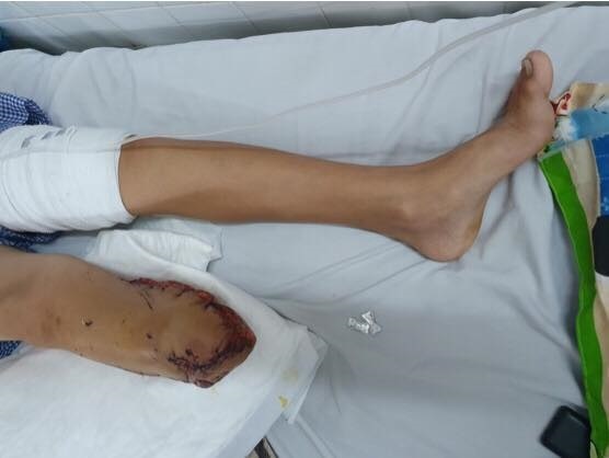 Bé trai 12 tuổi lái xe máy ngã phải cưa chân